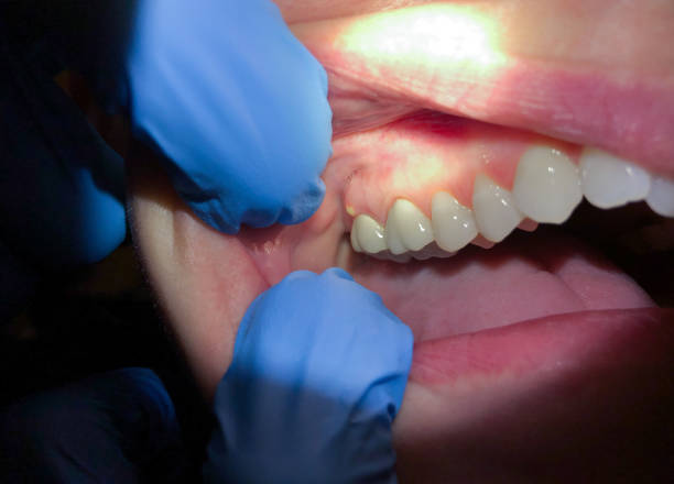 Best Broken or Chipped Tooth Repair in Kennett Square, PA