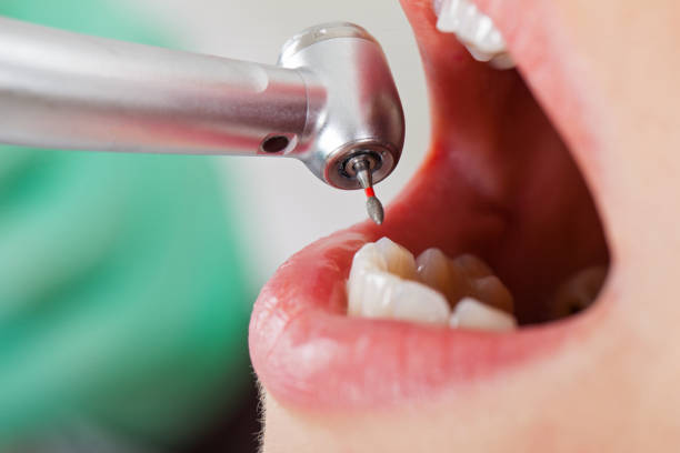 Best Broken or Chipped Tooth Repair in Kennett Square, PA